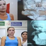 Granada se Aloja no Rosto de uma Mulher e Não Explode Granada se Aloja no Rosto de uma Mulher e Não Explode