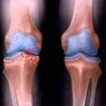 Saiba Como Prevenir a Artrose