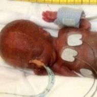 Bebê de 275g Sobrevive e Sai da UTI