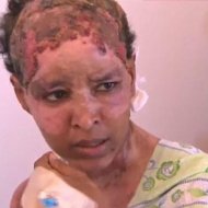 Mulher Torturada pela Nora de Kadhaf Será Cuidada por Médicos Brasileiros