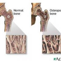 Reverta o Processo da Osteoporose com o Pilates