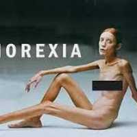 Transtornos Alimentares: Anorexia Nervosa
