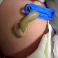MÃ©dicos Extirpam PÃªnis de BebÃª Por Confundirem com CordÃ£o Umbilical