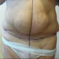 Mulher Faz Cirurgia de Estômago e Acorda com Pênis Implantado